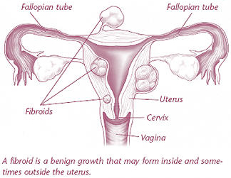 Hysteroscopy